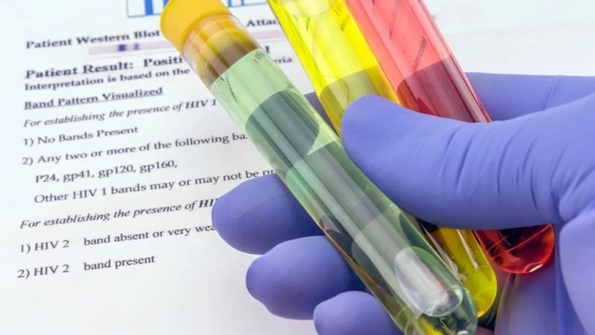 Séc có nguy cơ lập kỷ lục về số ca nhiễm HIV, bác sĩ lý giải nguyên nhân gia tăng